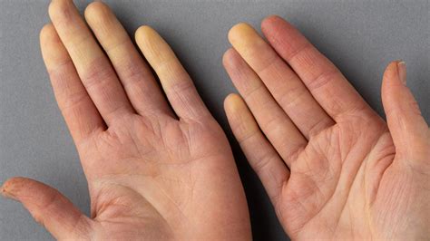 Raynaud Phenomenon 